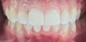 Clear Aligners After