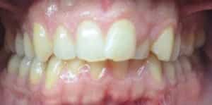 Clear Aligners Before