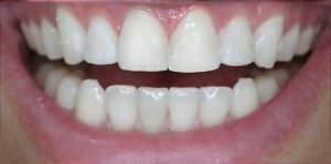 before and after teeth alignment