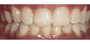 Teeth Align Before