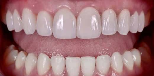 Dental Veneers After chipped teeth