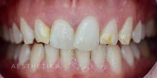 Porcelain Veneers Melbourne with cracked teeth