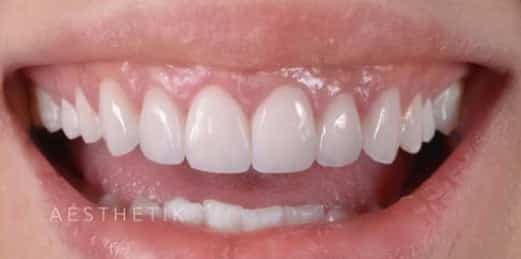 Porcelain Veneers Melbourne after correctly implemented teeth