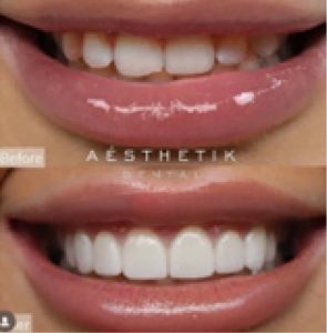 before and after dental veneers