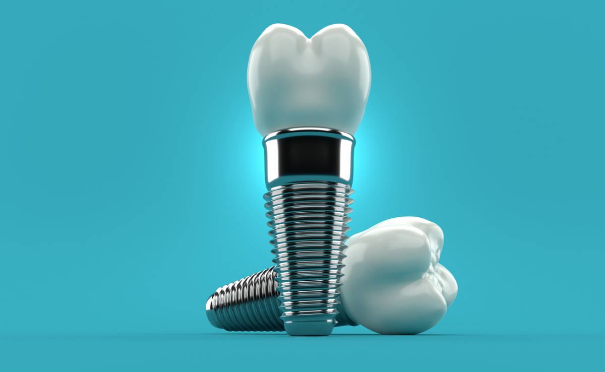 What to Expect on Dental Implant Surgery Day: A Patient’s Complete Guide