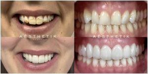 cons of veneers