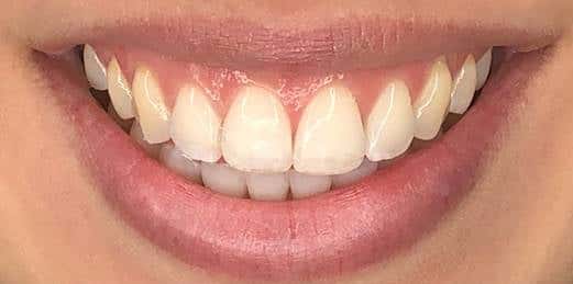 Before Invisalign Treatment